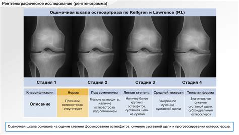 Современные методы диагностики и лечения боли в коленном суставе по коду МКБ-10